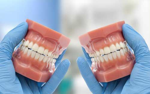 磨牙症与夜磨牙的病因