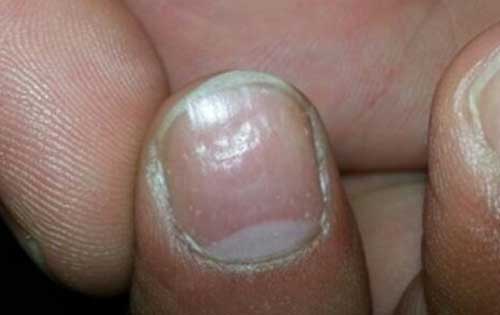 我的指甲有竖纹，是身体发出的什么信号