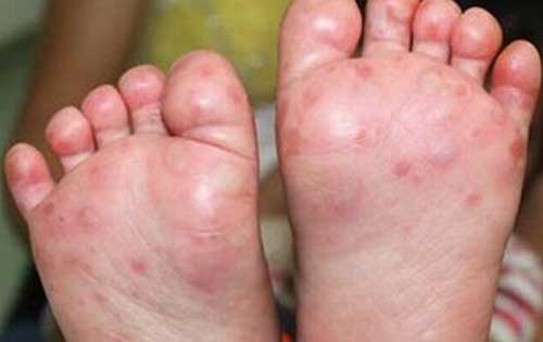 手足口病症状初期图片判断病情|手足口病患者都有哪些表现