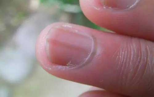 我的指甲有竖纹，是身体发出的什么信号